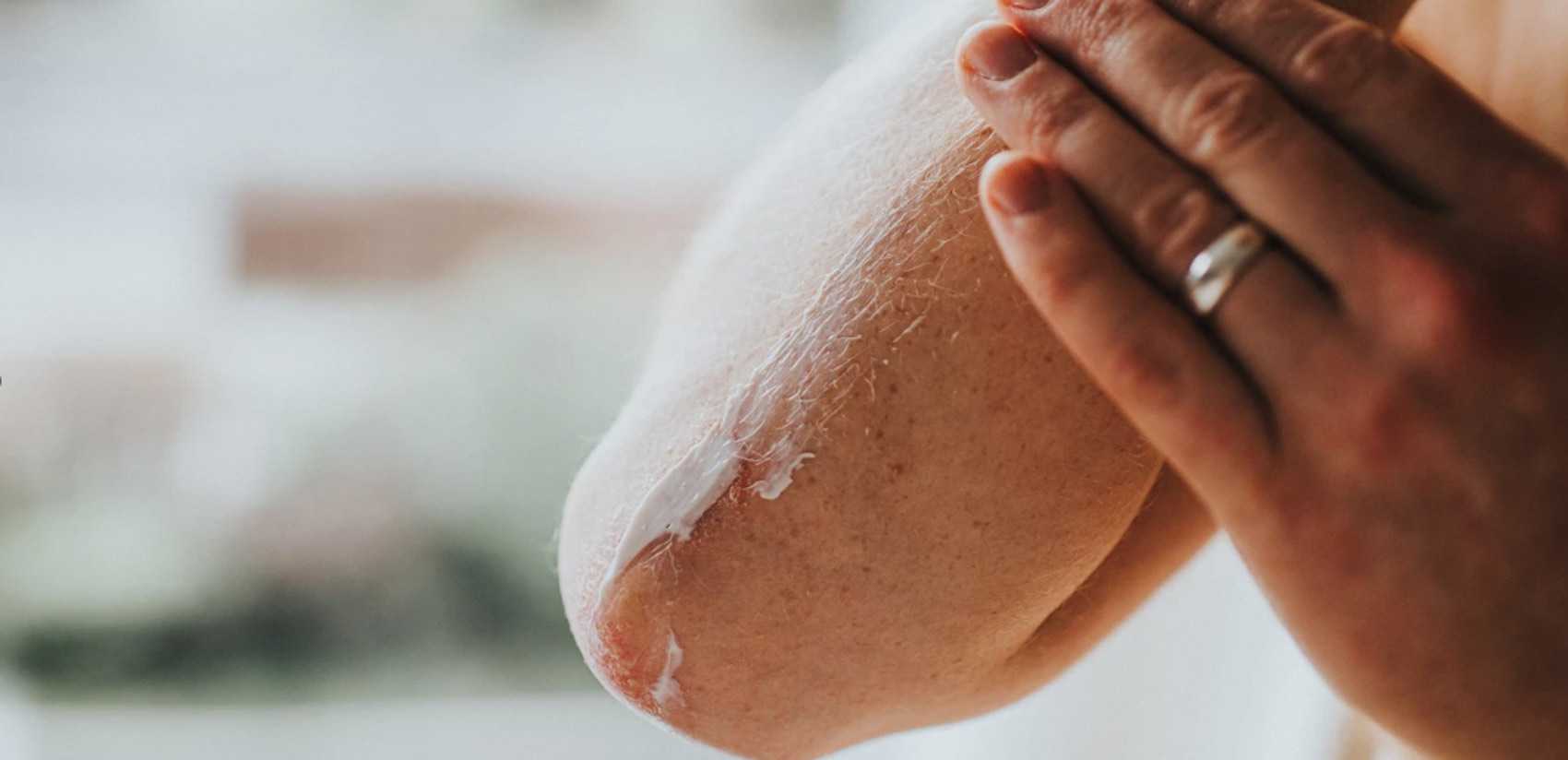 arm with alopecia